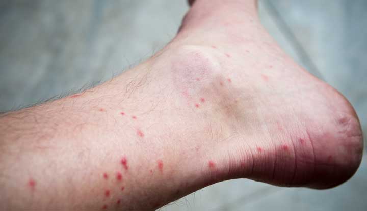 cat flea affect on human leg