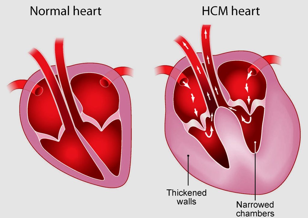 Normal vs HCM heart